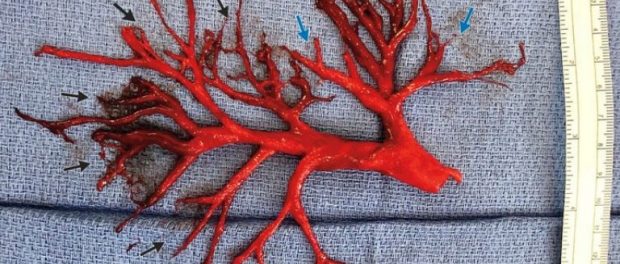 bizarre-blood-clot-768x400